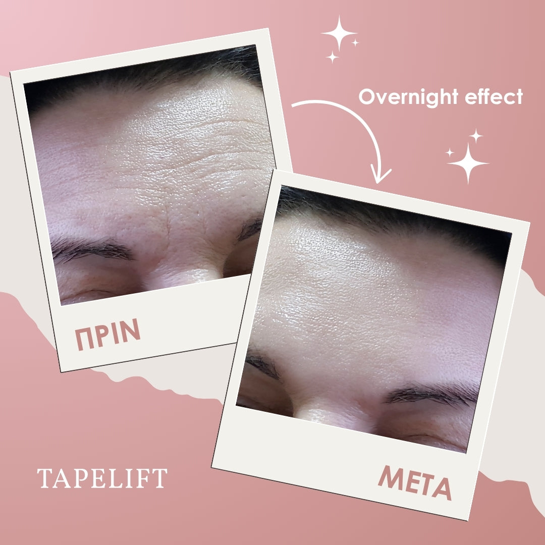 TAPELIFT™ Ταινίες Προσώπου για Φυσικό Lifting