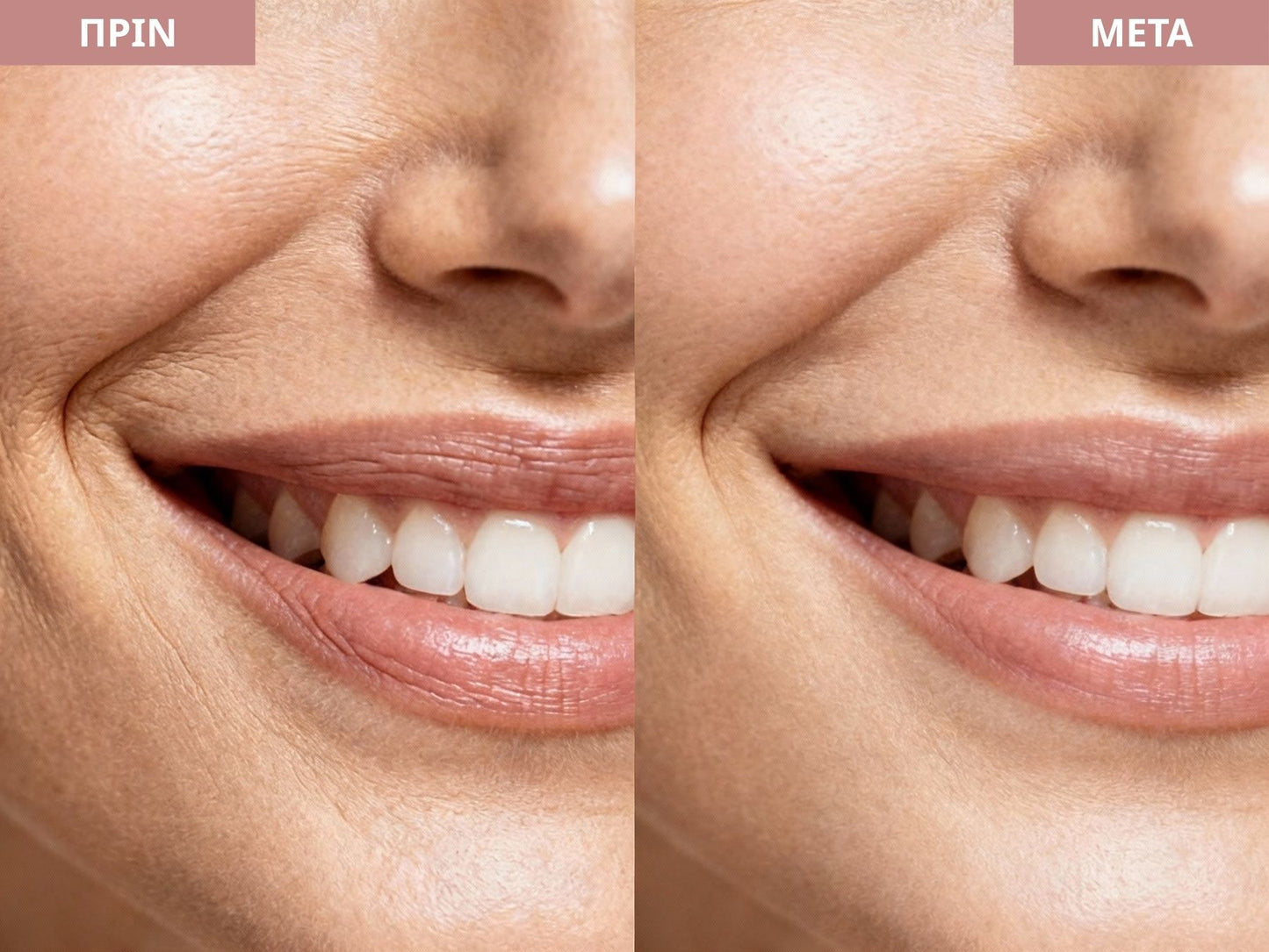 TAPELIFT™ Ταινίες Προσώπου για Φυσικό Lifting