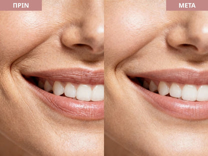 TAPELIFT™ Ταινίες Προσώπου για Φυσικό Lifting